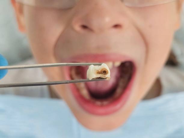 Best Emergency Dentist for Knocked-Out Tooth in Agler Estates, FL